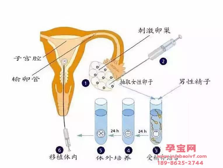  试管婴儿