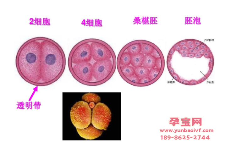  试管婴儿