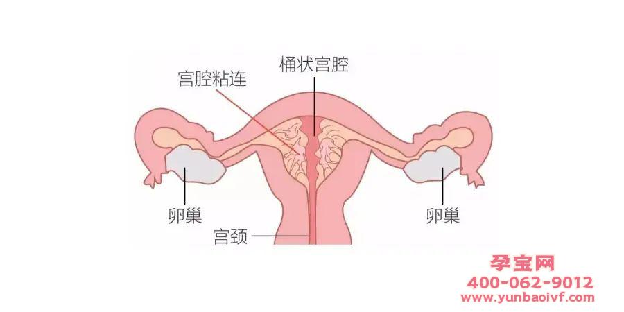 试管婴儿